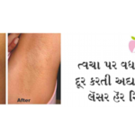 ત્વચા પર વધારાના વાળ દૂર કરતી અદ્યતન તકનીક લૅસર હૅર રિમુવલ