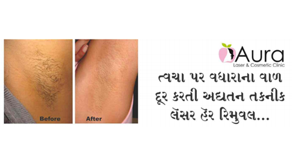 ત્વચા પર વધારાના વાળ દૂર કરતી અદ્યતન તકનીક લૅસર હૅર રિમુવલ